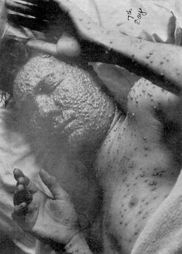 Smallpox Photo