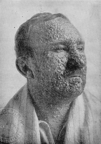 Smallpox Photo