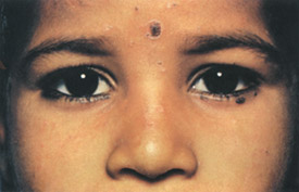 Chickenpox day 10