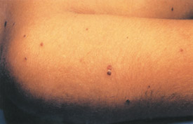 Chickenpox day 10