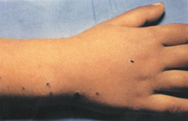 Chickenpox day 10