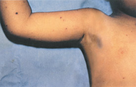 Chickenpox day 10