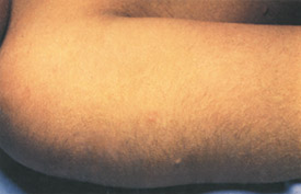 Chickenpox day 2