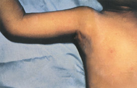 Chickenpox day 2