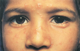 Chickenpox day 3