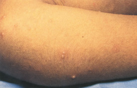 Chickenpox day 3