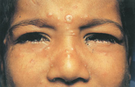 Chickenpox day 4