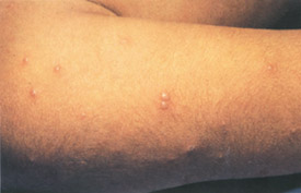 Chickenpox day 4
