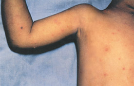 Chickenpox day 4