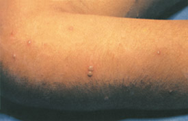 Chickenpox day 5