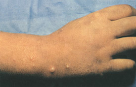 Chickenpox day 5