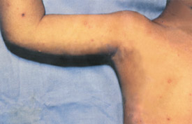 Chickenpox day 5