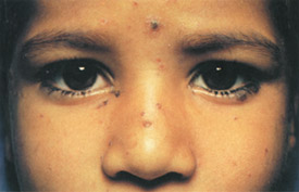Chickenpox day 7