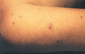 Chickenpox day 7