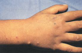 Chickenpox day 7