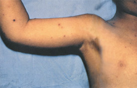 Chickenpox day 7