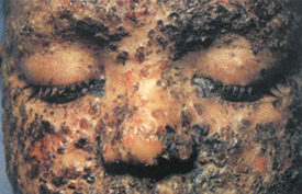 Smallpox day 10