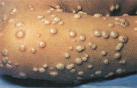 Smallpox day 10
