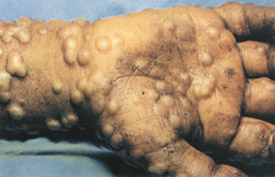 Smallpox day 10
