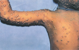 Smallpox day 10