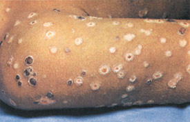 Smallpox day 7