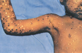 Chickenpox day 7