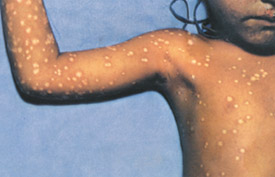 Chickenpox day 10