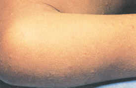 Smallpox day 2