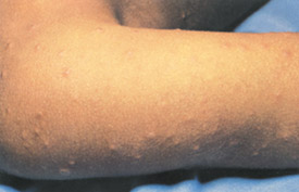 Smallpox day 3