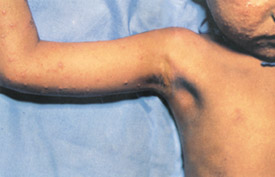 Smallpox day 3