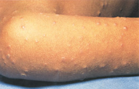Smallpox day 4