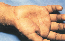 Smallpox day 4