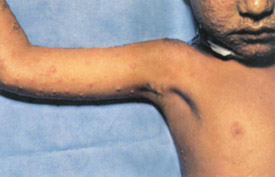 Smallpox day 4