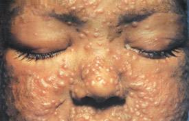 Smallpox day 5