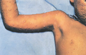Smallpox day 5