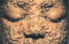 Smallpox day 7