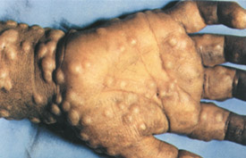 Smallpox day 7