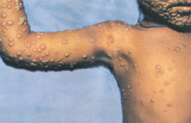 Smallpox day 7
